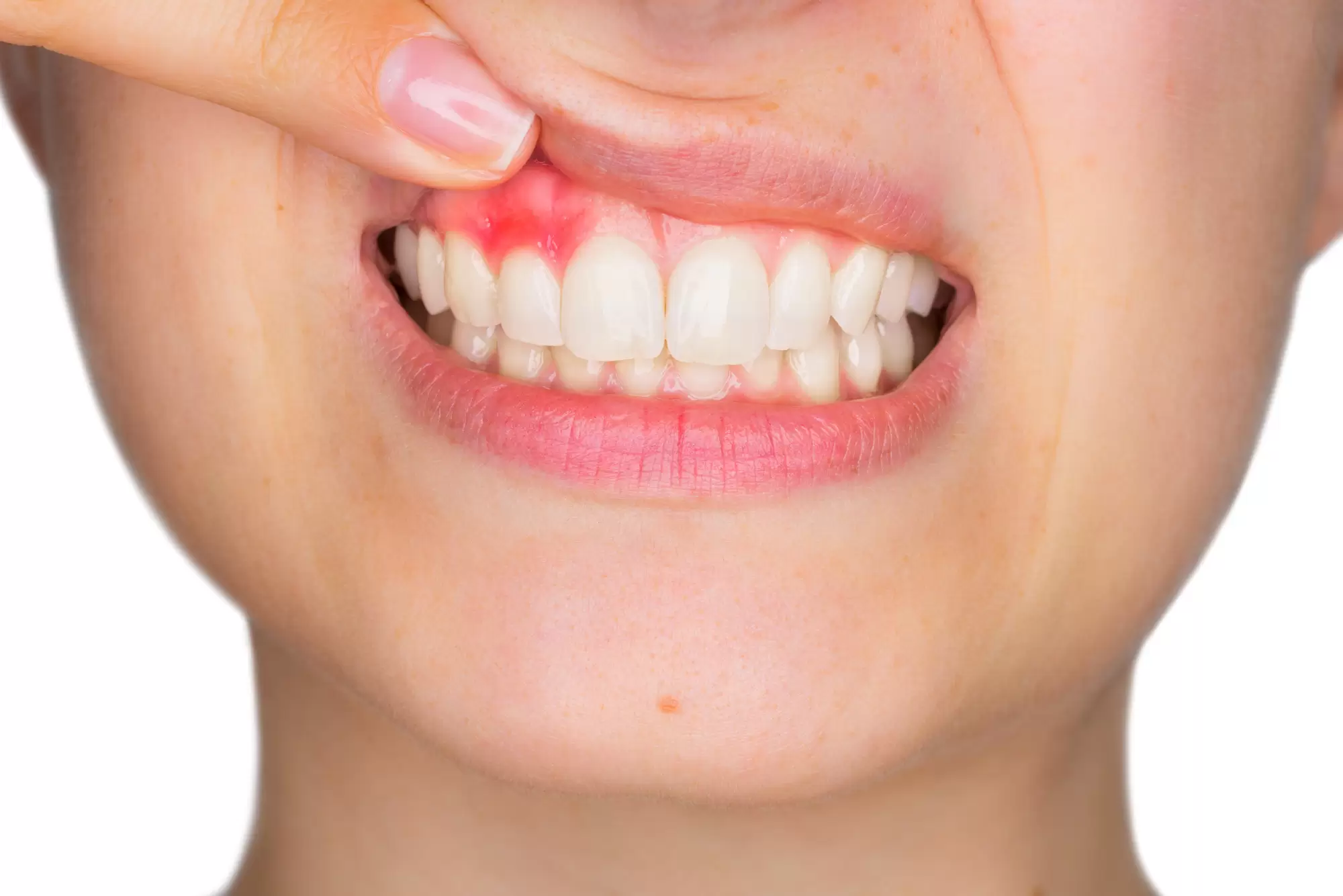 www.spiritselfhealth.com-gingivitis